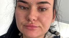 Open wounds and eyes that can't close - women warn about cheap bleph eyelid surgery